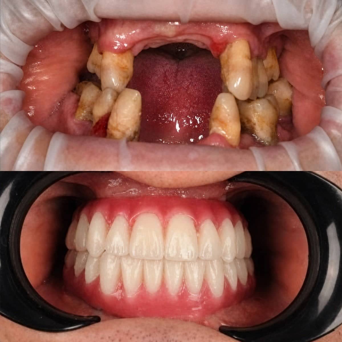 Case 13626 - dental prosthetics installation