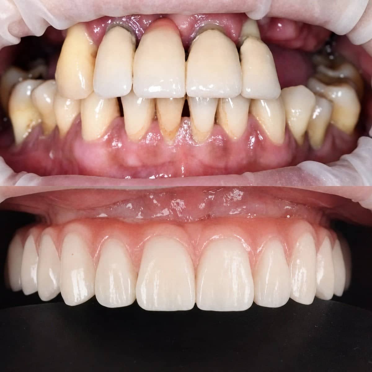 Case 13627 - dental prosthetics installation
