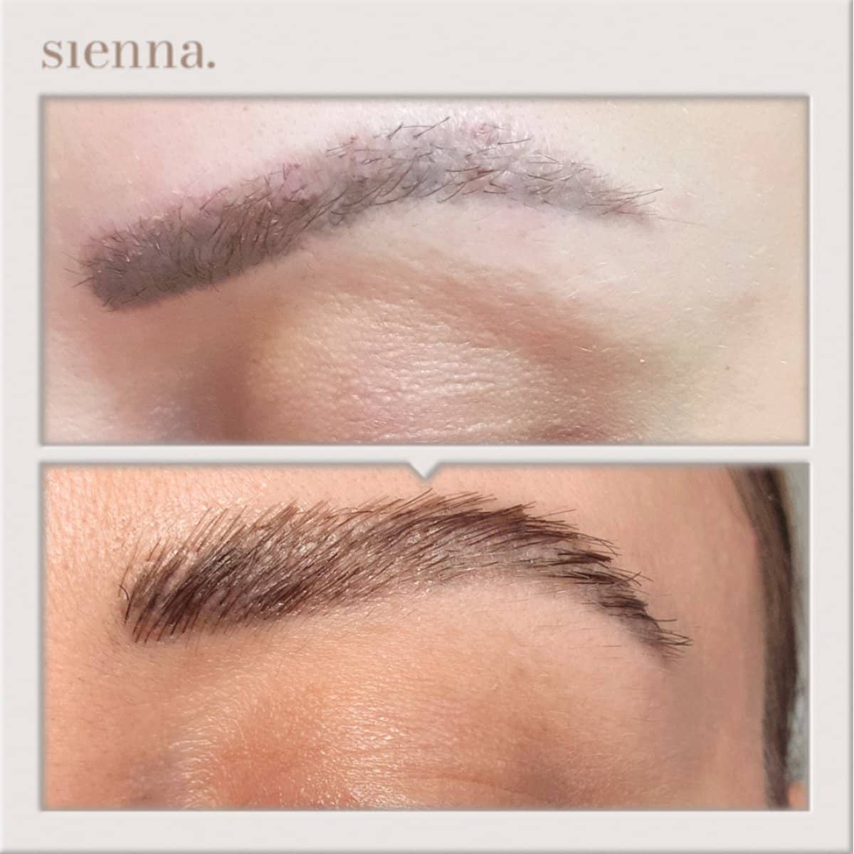 Case 13648 - eyebrow transplant
