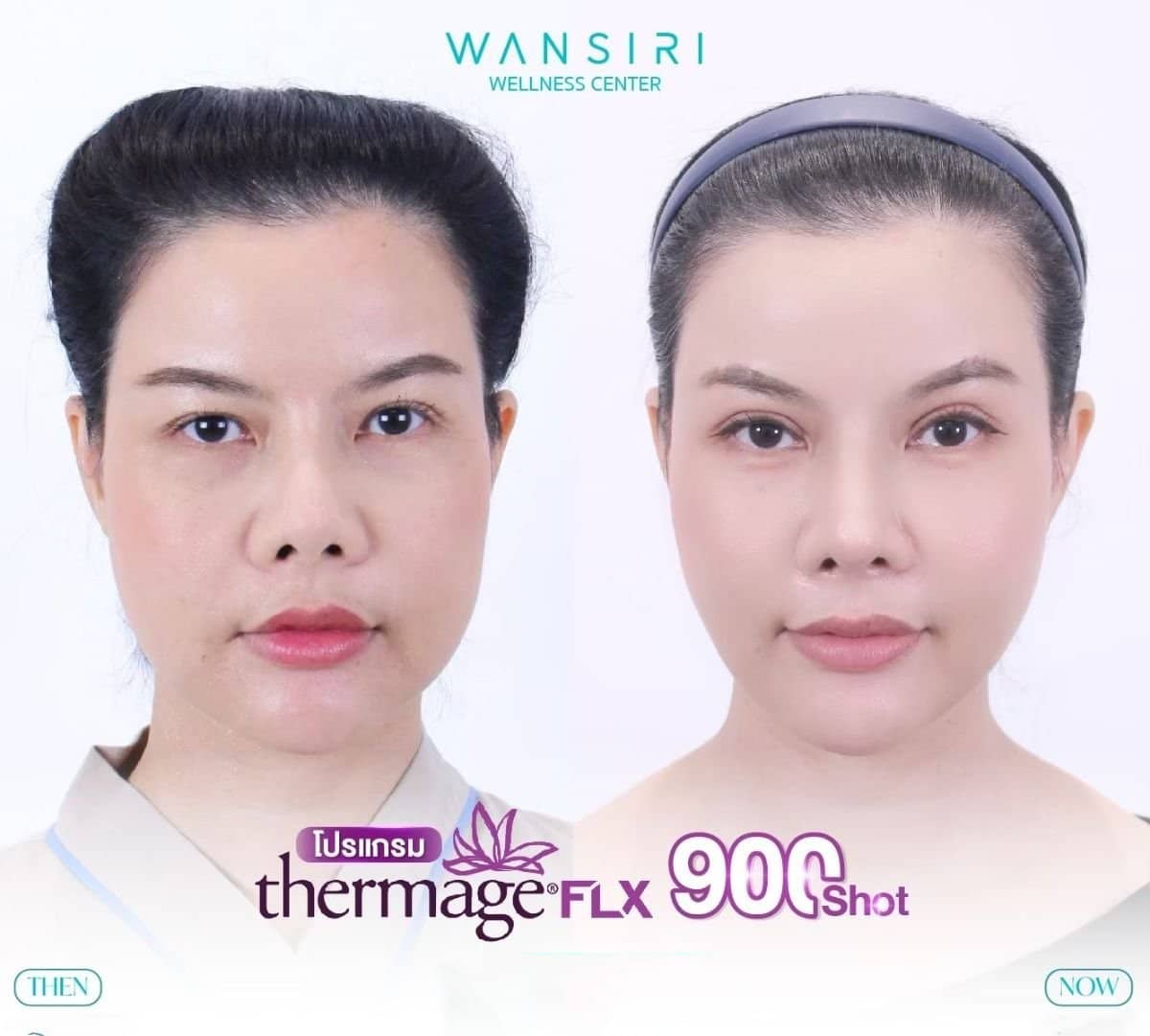 Case 13677 - Thermage FLX