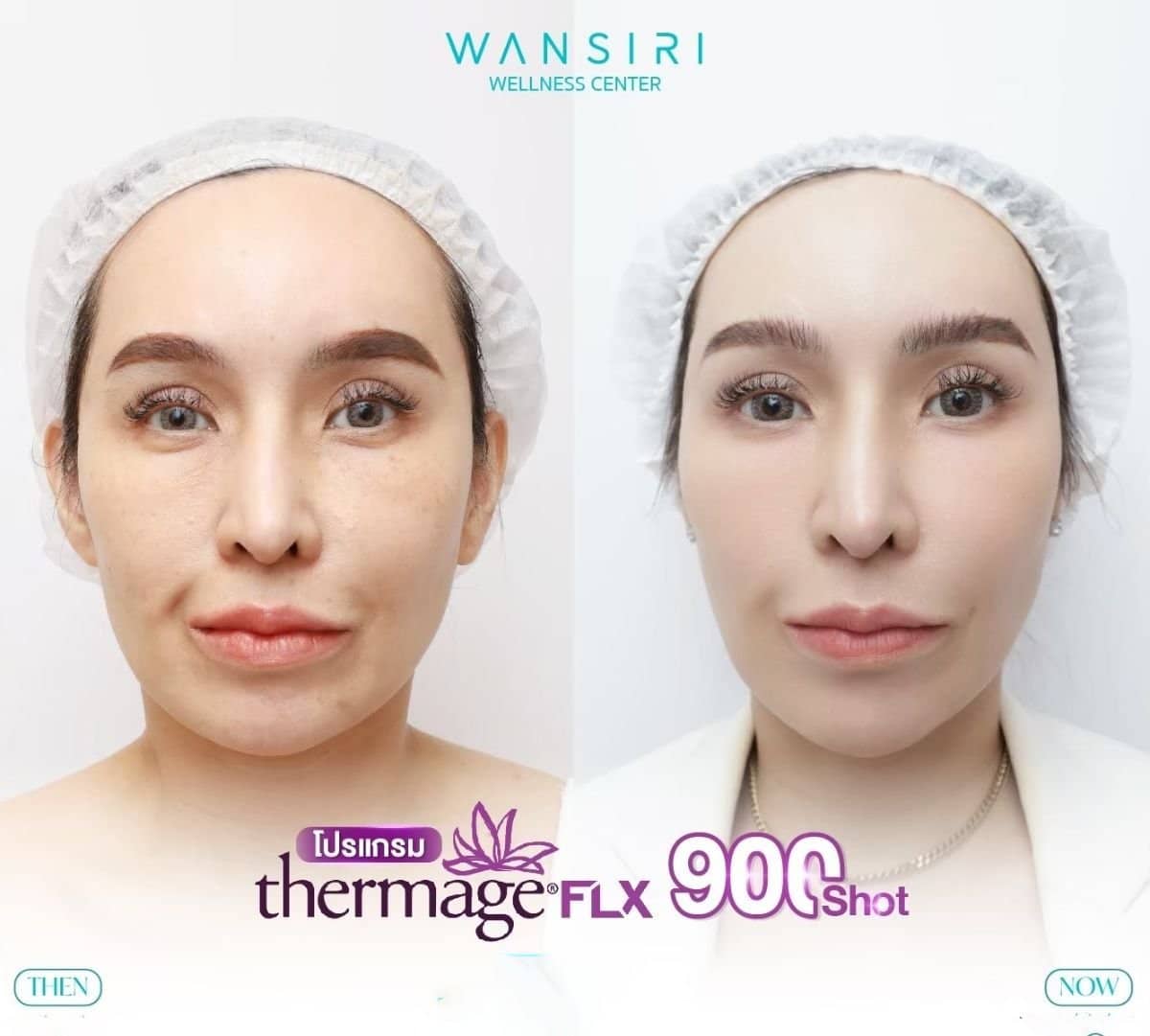 Case 13680 - Thermage FLX