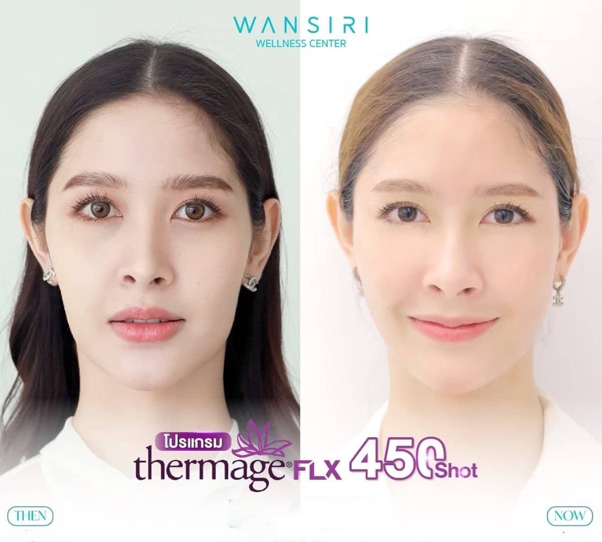 Case 13681 - Thermage FLX