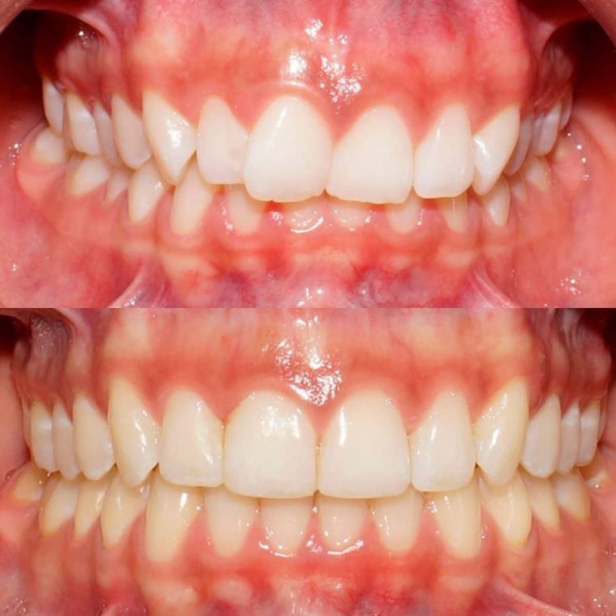 Case 13701 - dental veneers