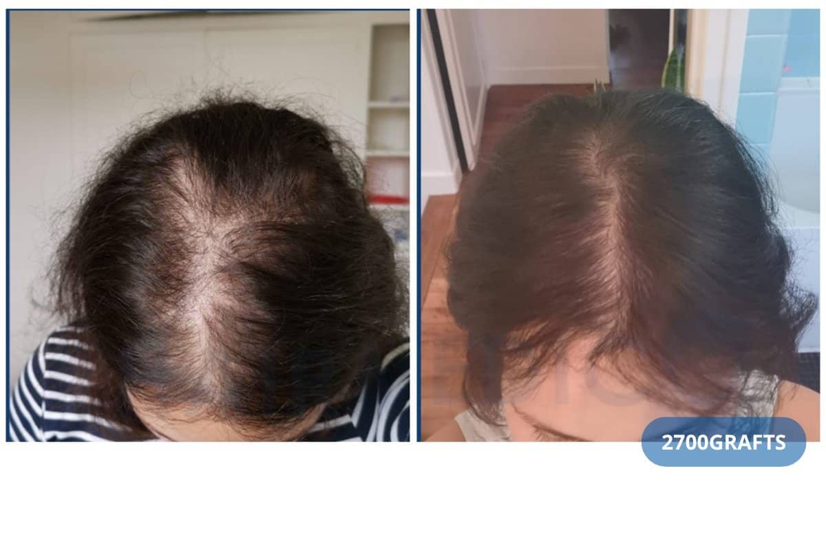Case 13711 - DHI hair transplant