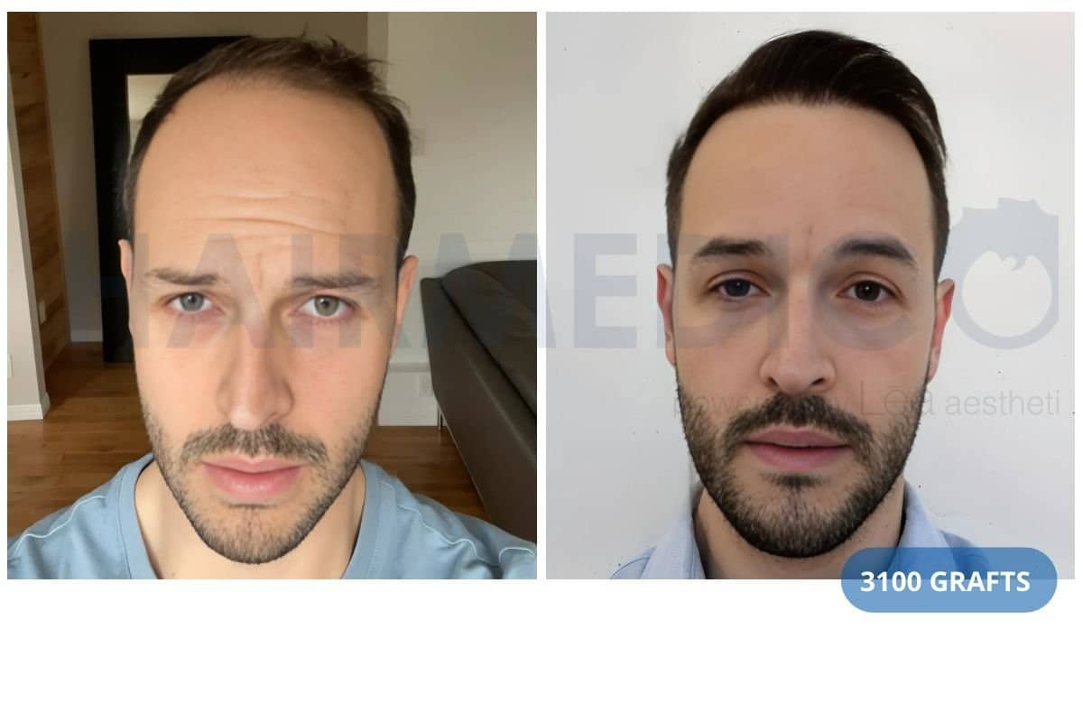 Case 13713 - 3100 grafts hair transplant
