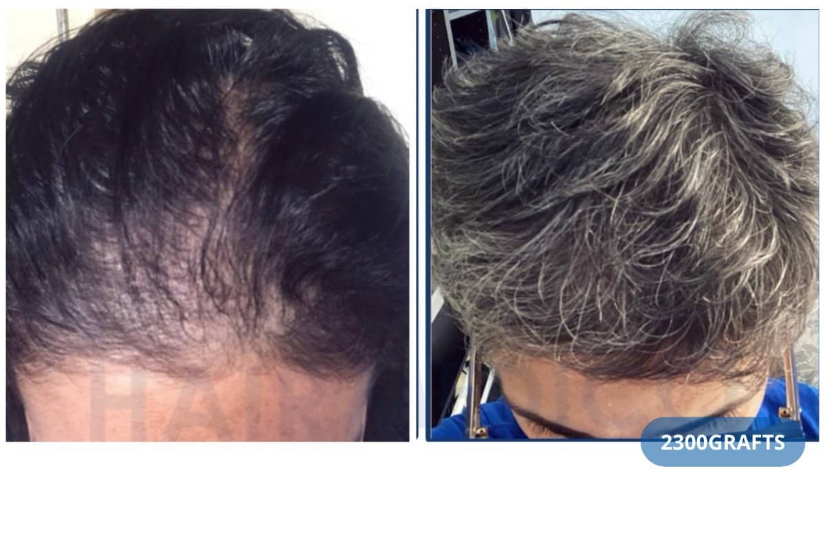 Case 13721 - DHI hair transplant