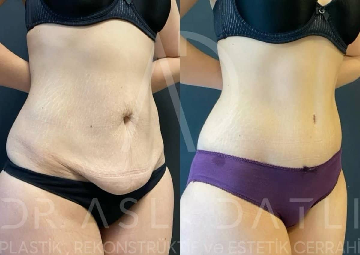 Case 13752 - BodyTite body contouring