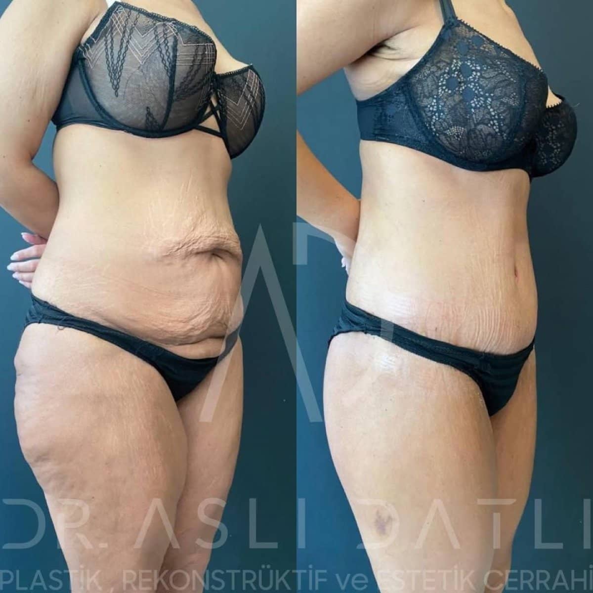 Case 13762 - 360 liposuction