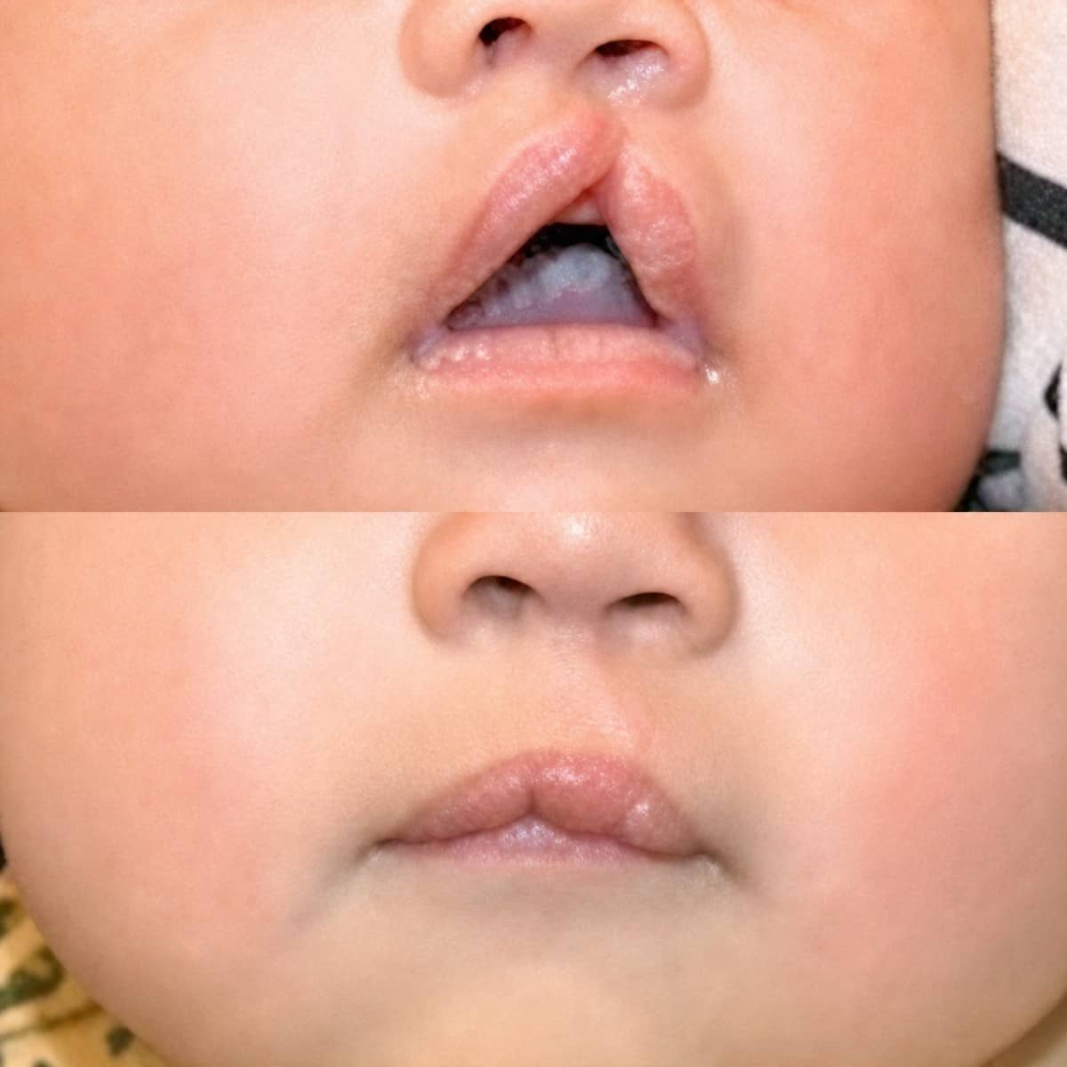 Case 13789 - cleft lip repair