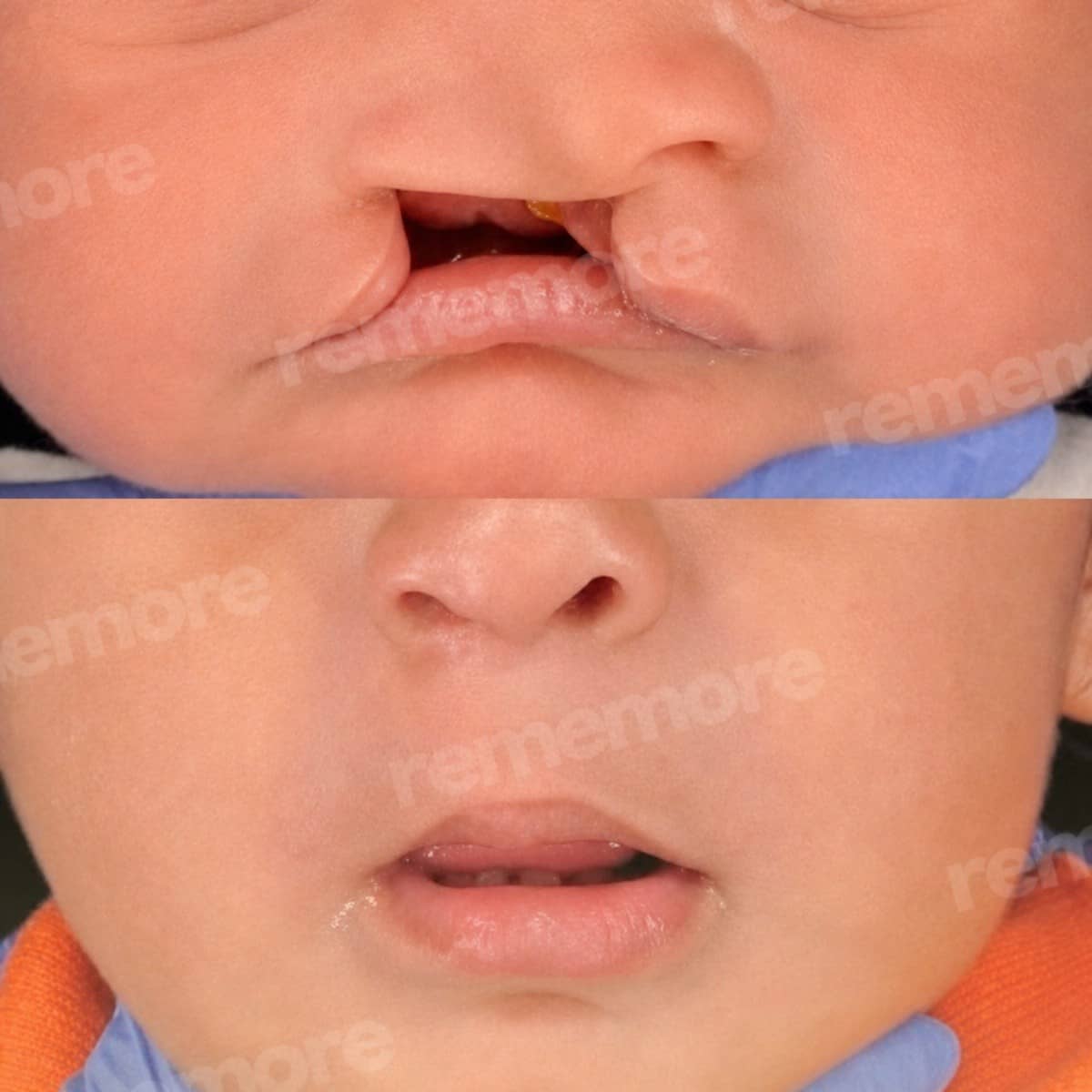 Case 13793 - cleft lip repair