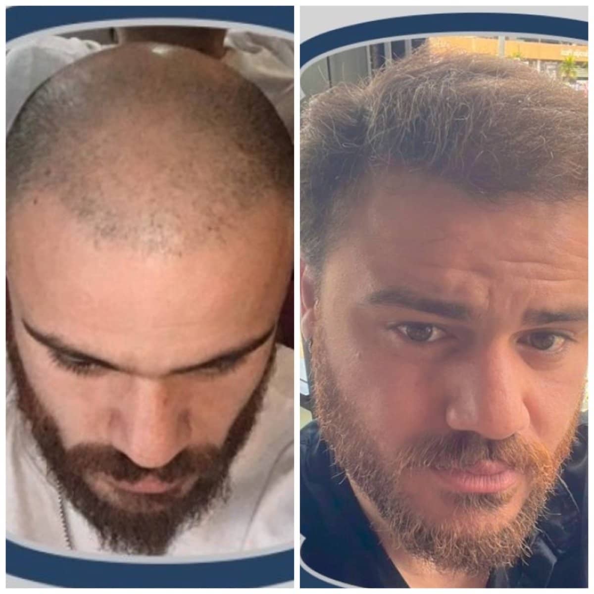 Case 13805 - DHI hair transplant