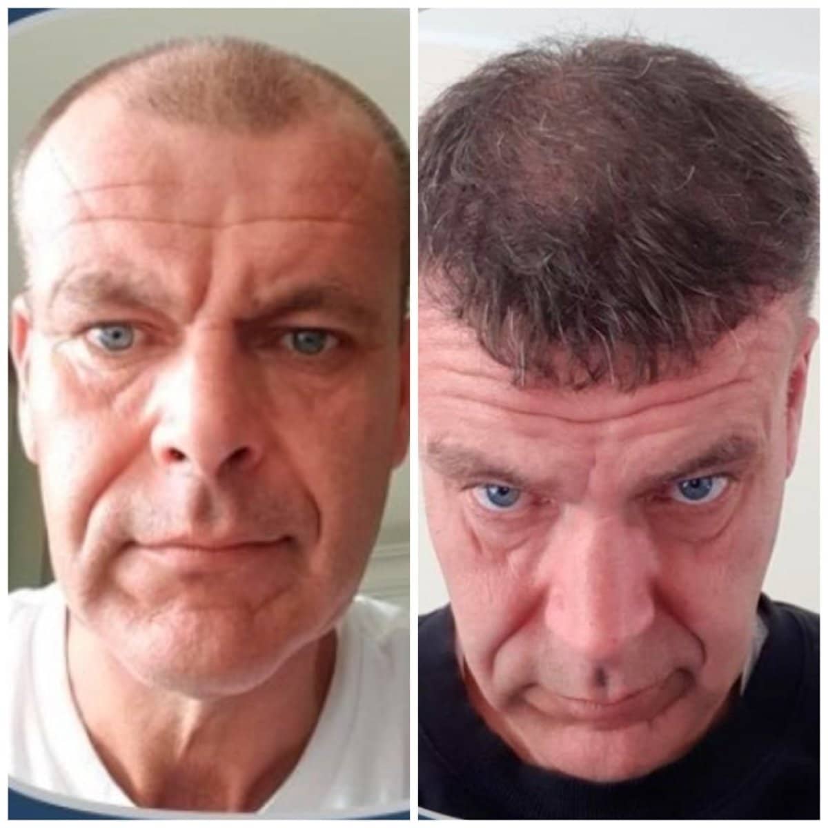 Case 13806 - DHI hair transplant