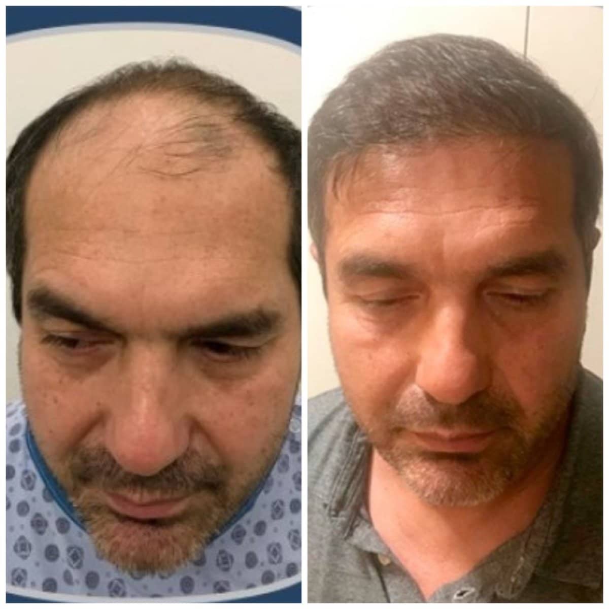 Case 13807 - DHI hair transplant