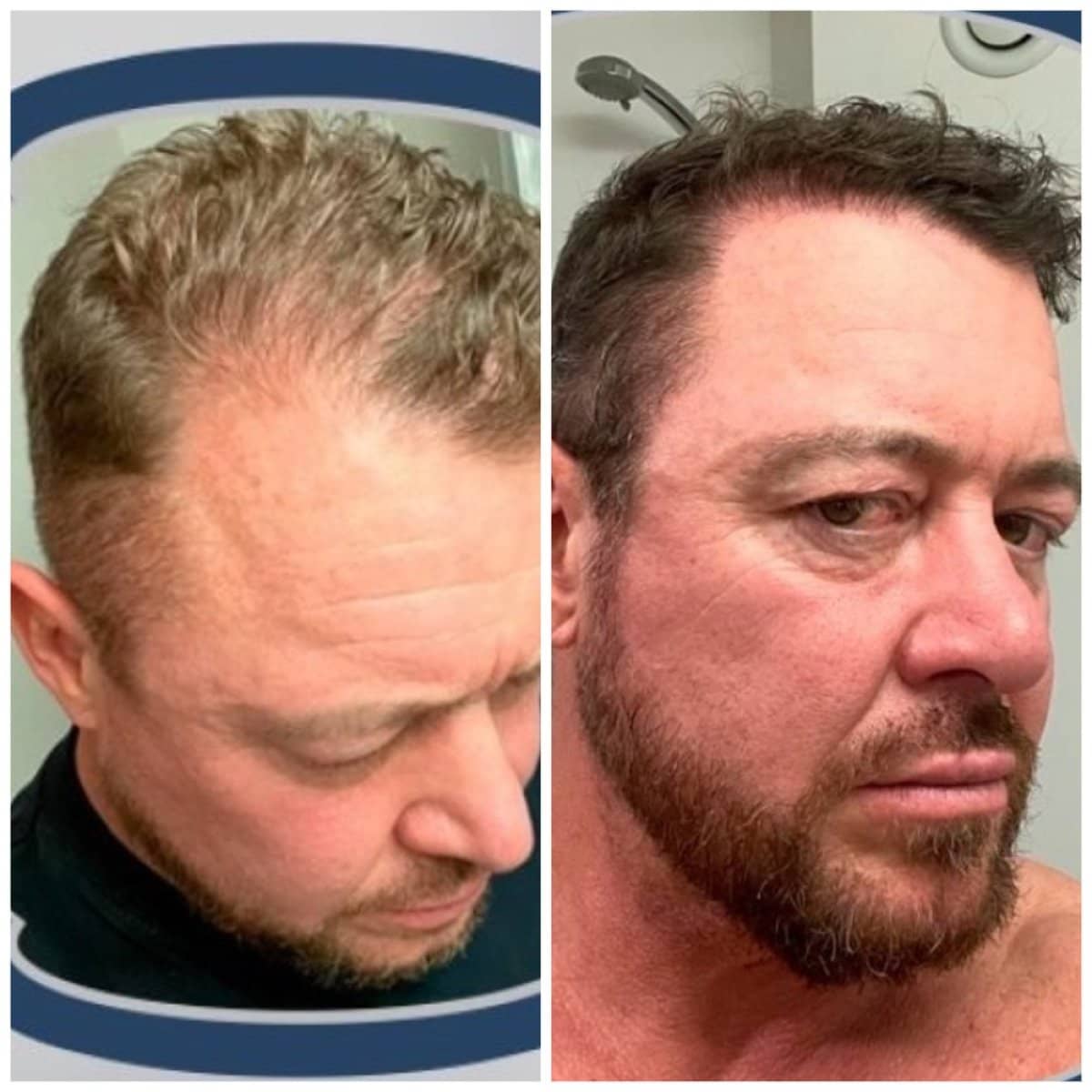 Case 13808 - DHI hair transplant