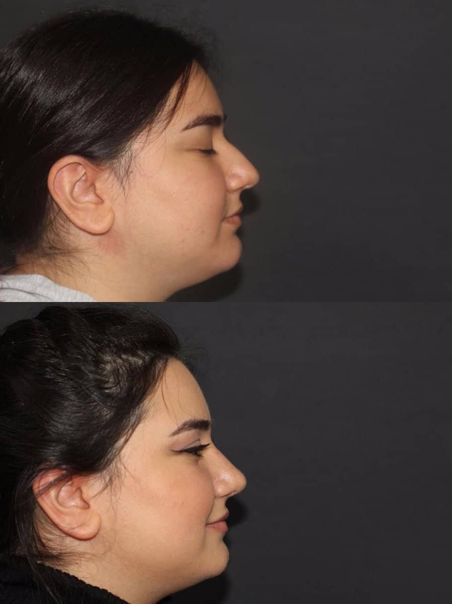 Case 13815 - rhinoplasty