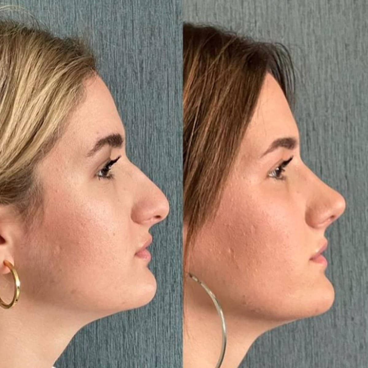 Case 13816 - rhinoplasty