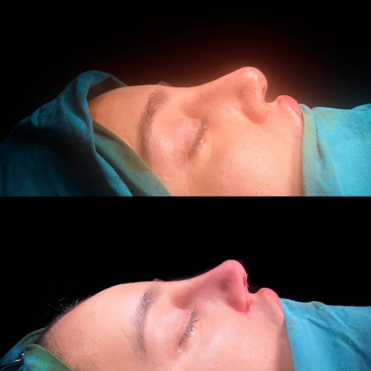Case 13817 - rhinoplasty