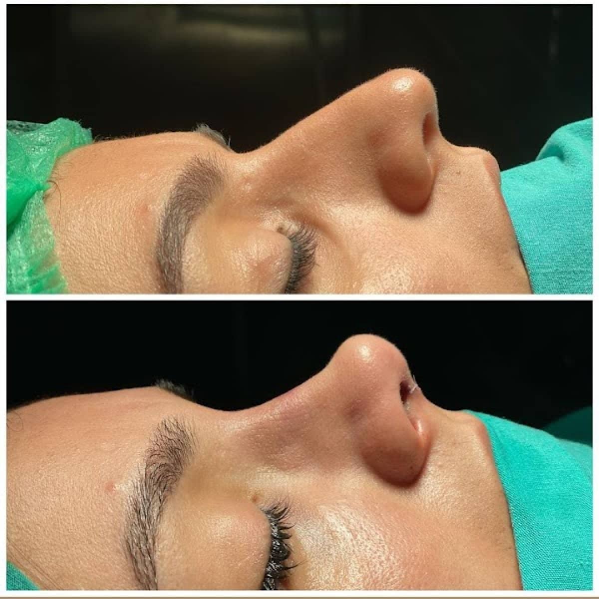 Case 13818 - revision rhinoplasty