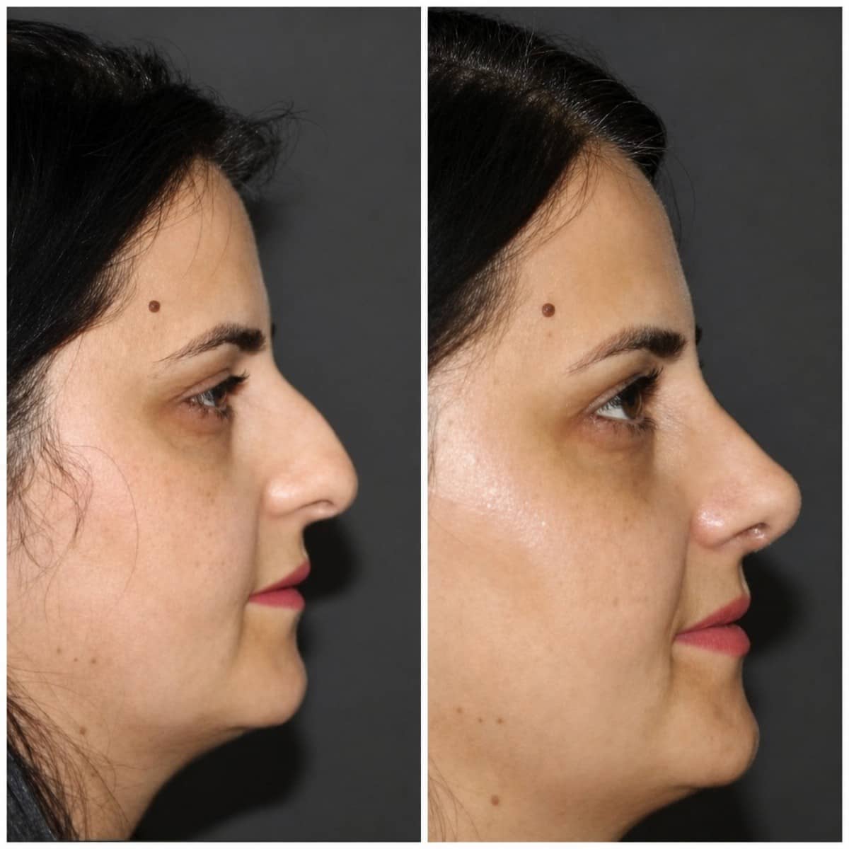 Case 13819 - rhinoplasty