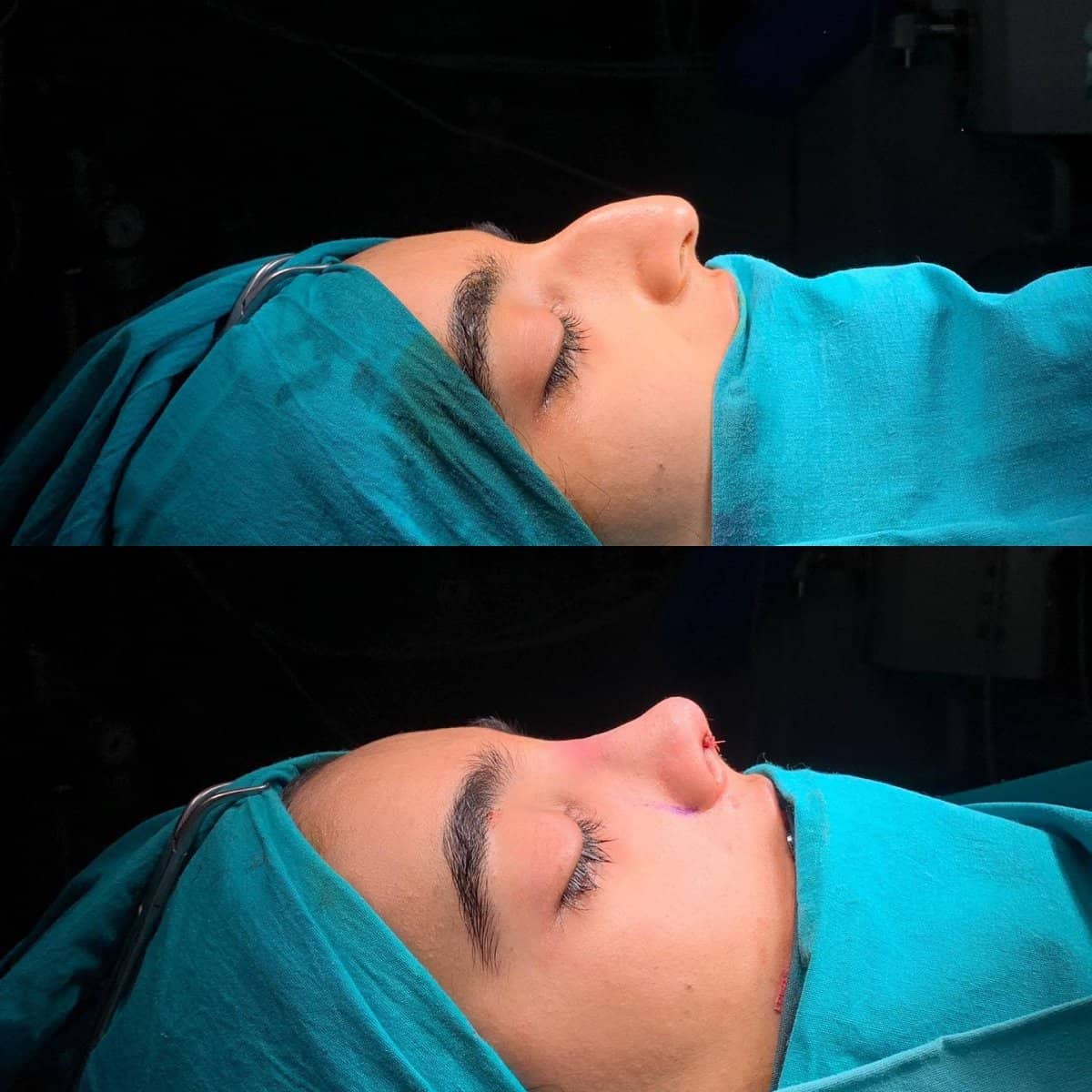 Case 13820 - rhinoplasty