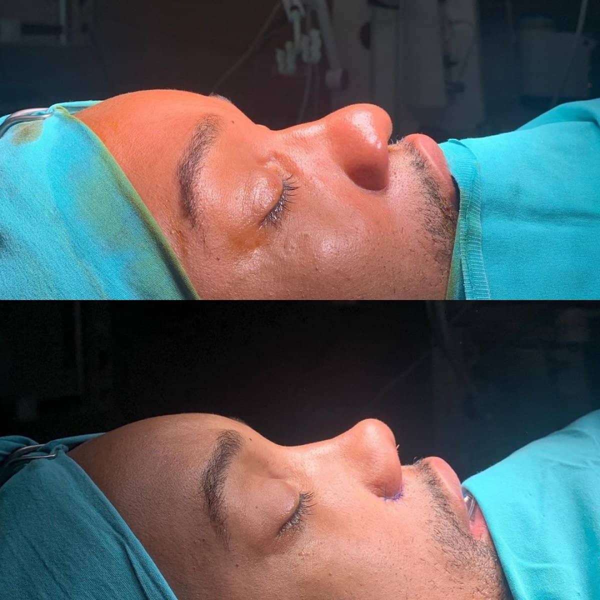 Case 13821 - rhinoplasty