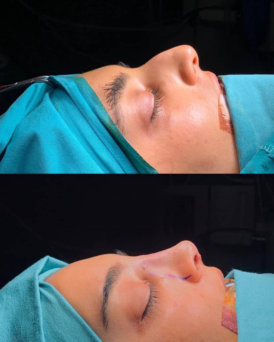 Case 13822 - rhinoplasty