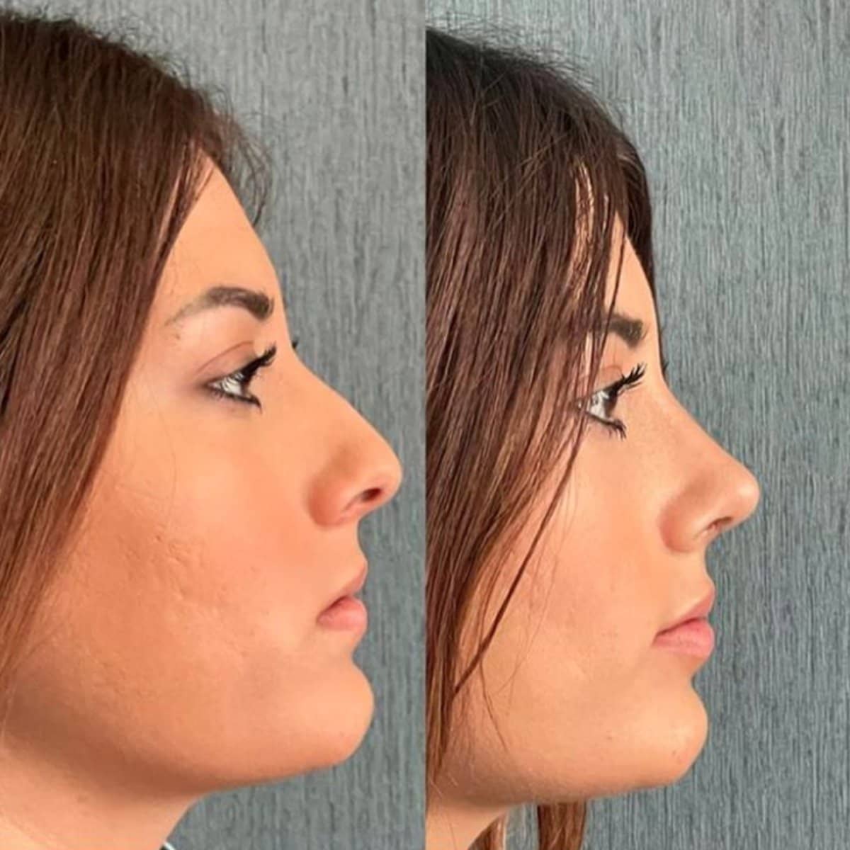 Case 13823 - rhinoplasty