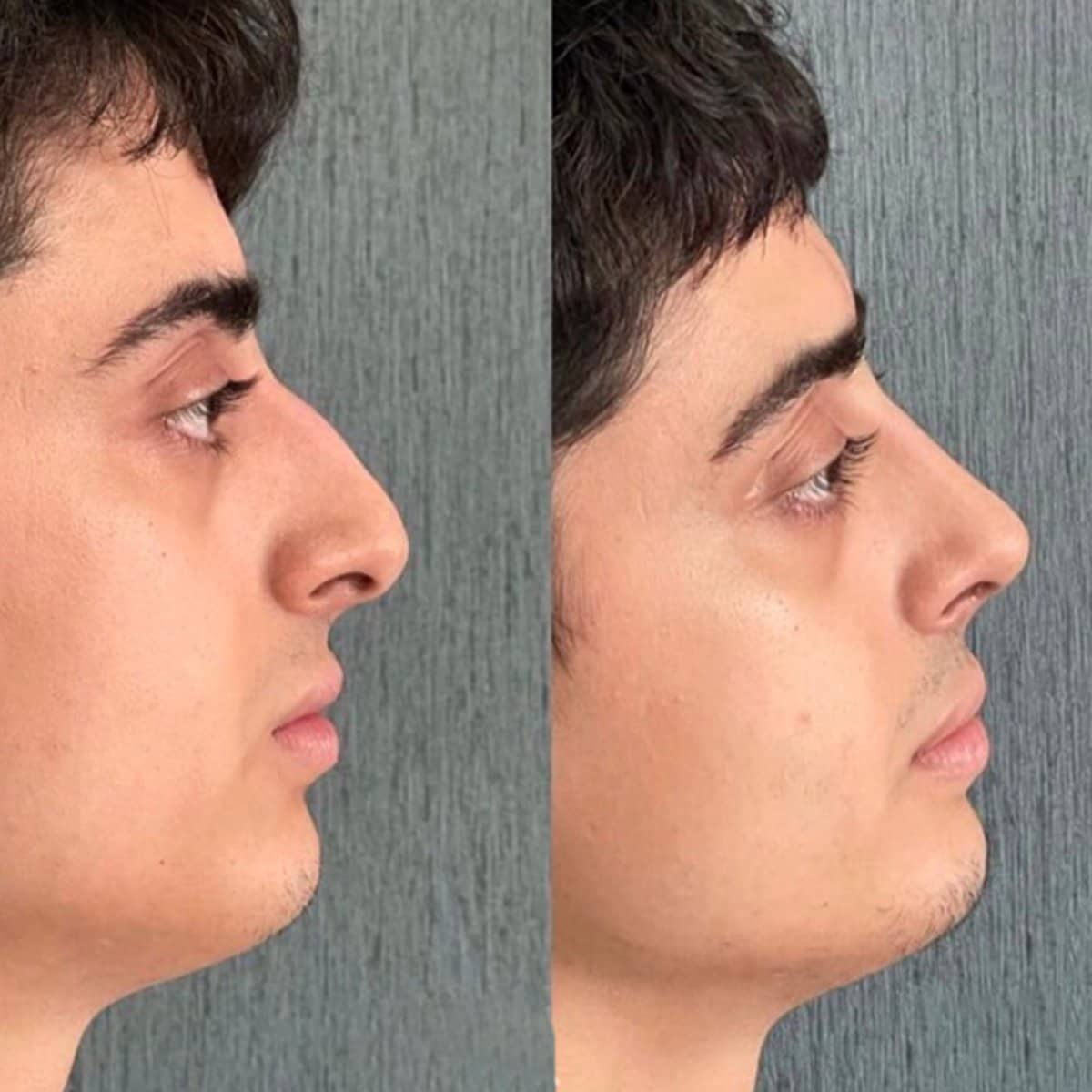 Case 13824 - rhinoplasty