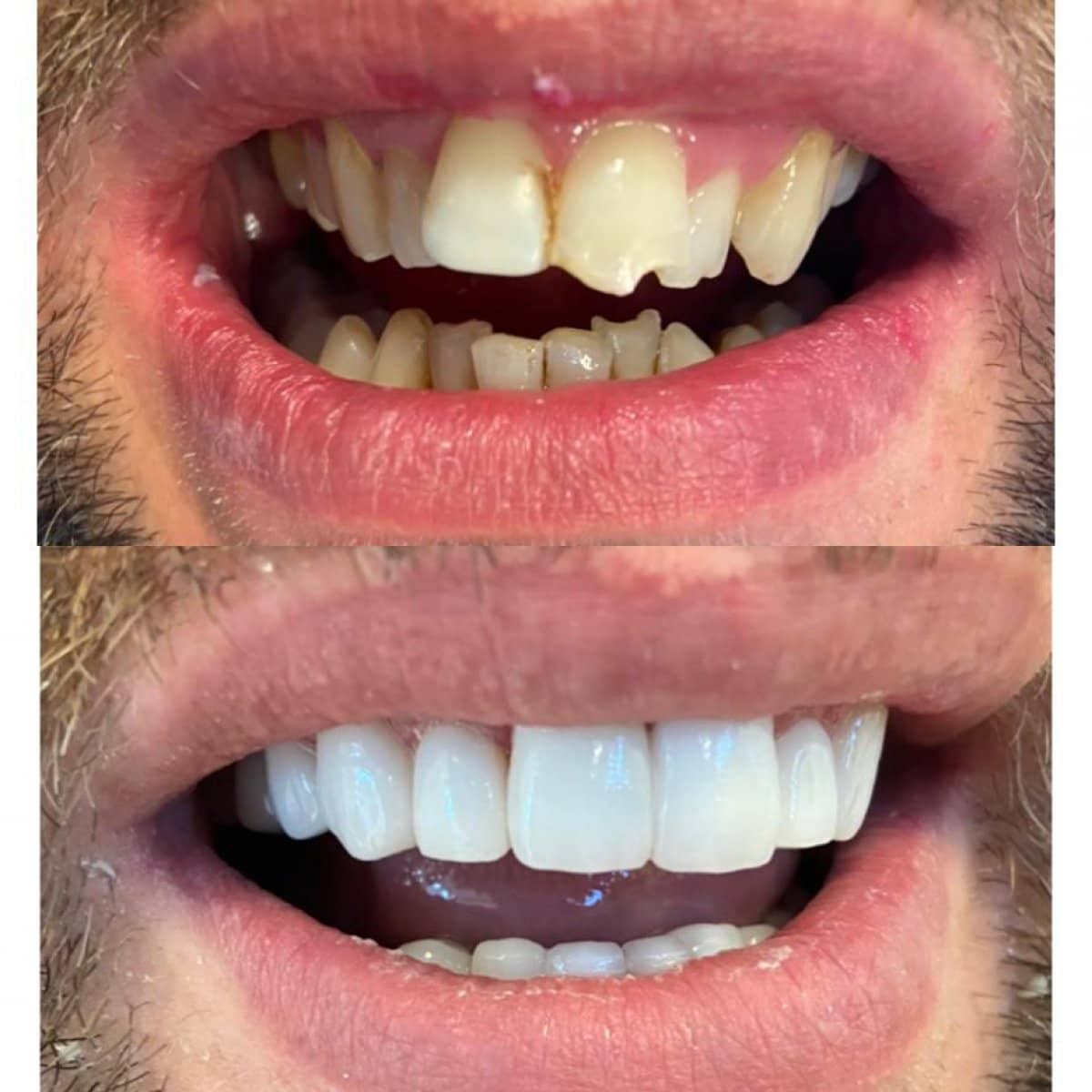 Case 13842 - veneers