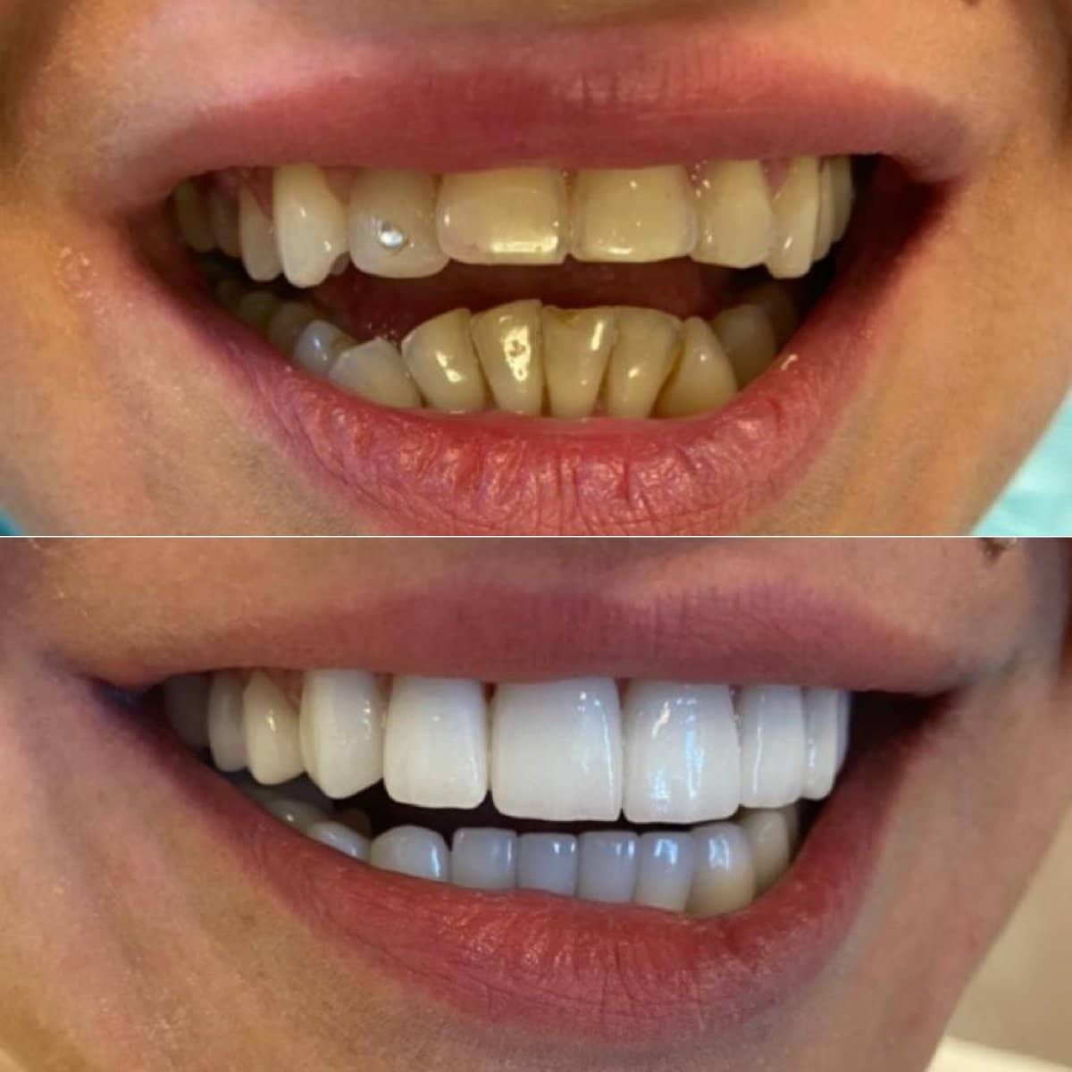 Case 13843 - veneers