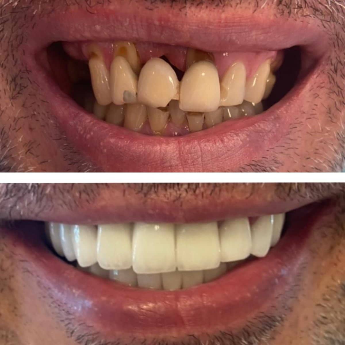 Case 13845 - veneers
