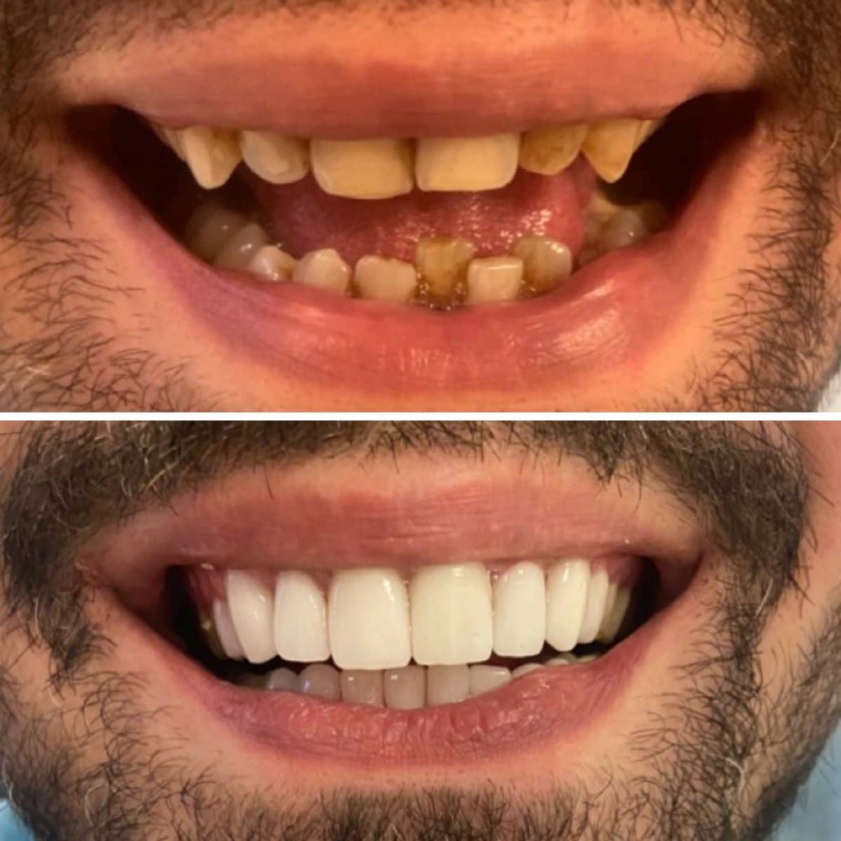 Case 13847 - veneers