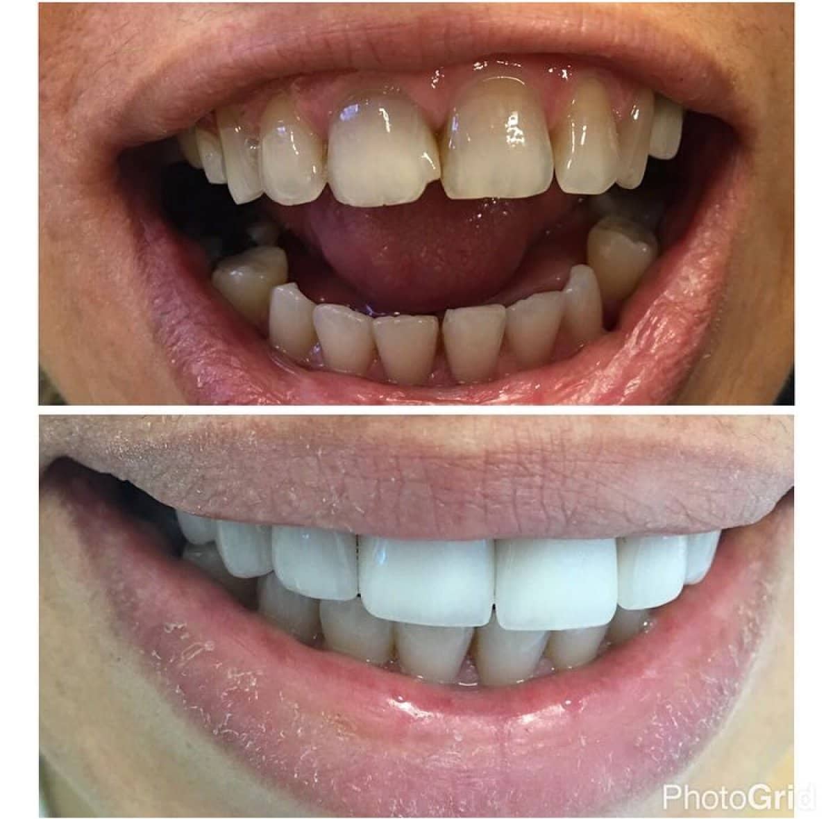 Case 13848 - dental crown installation