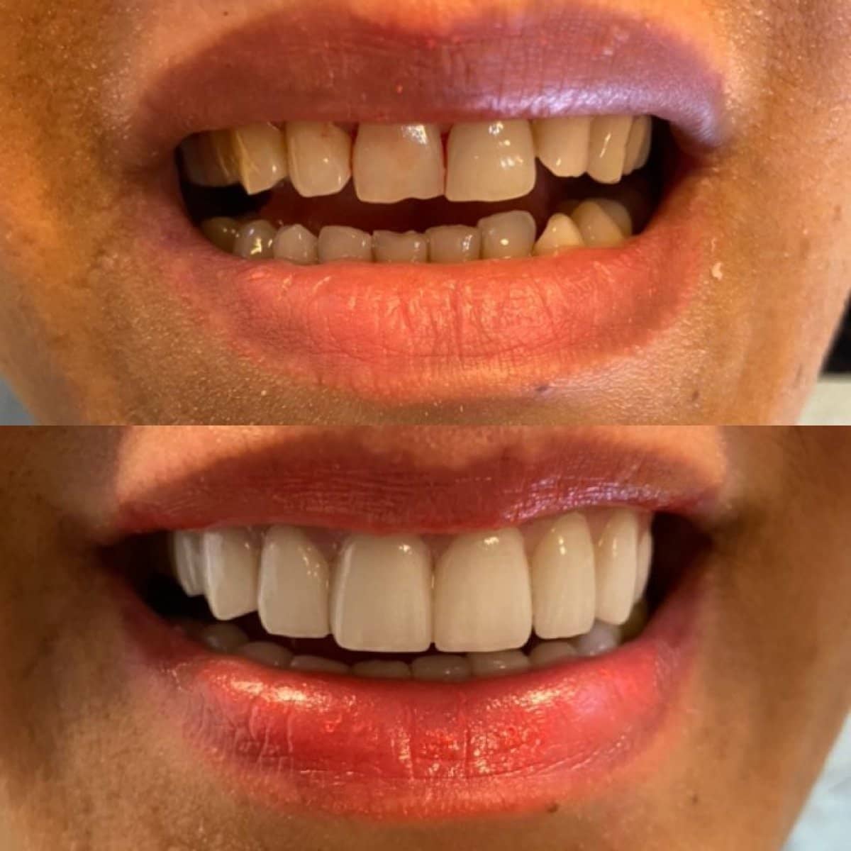 Case 13850 - veneers
