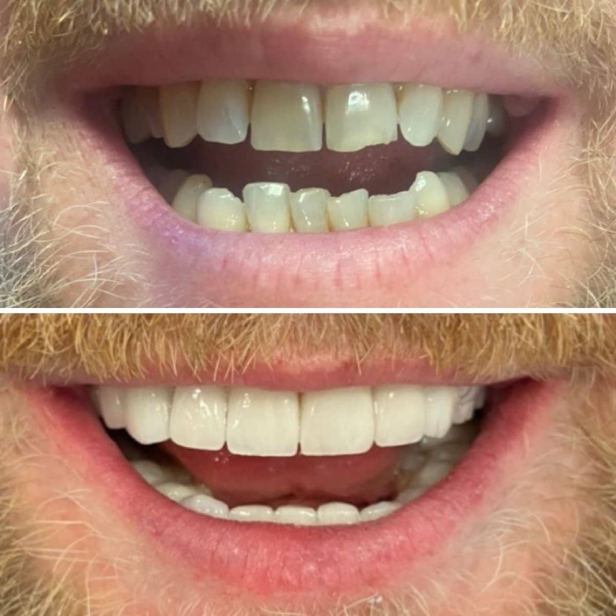 Case 13851 - veneers