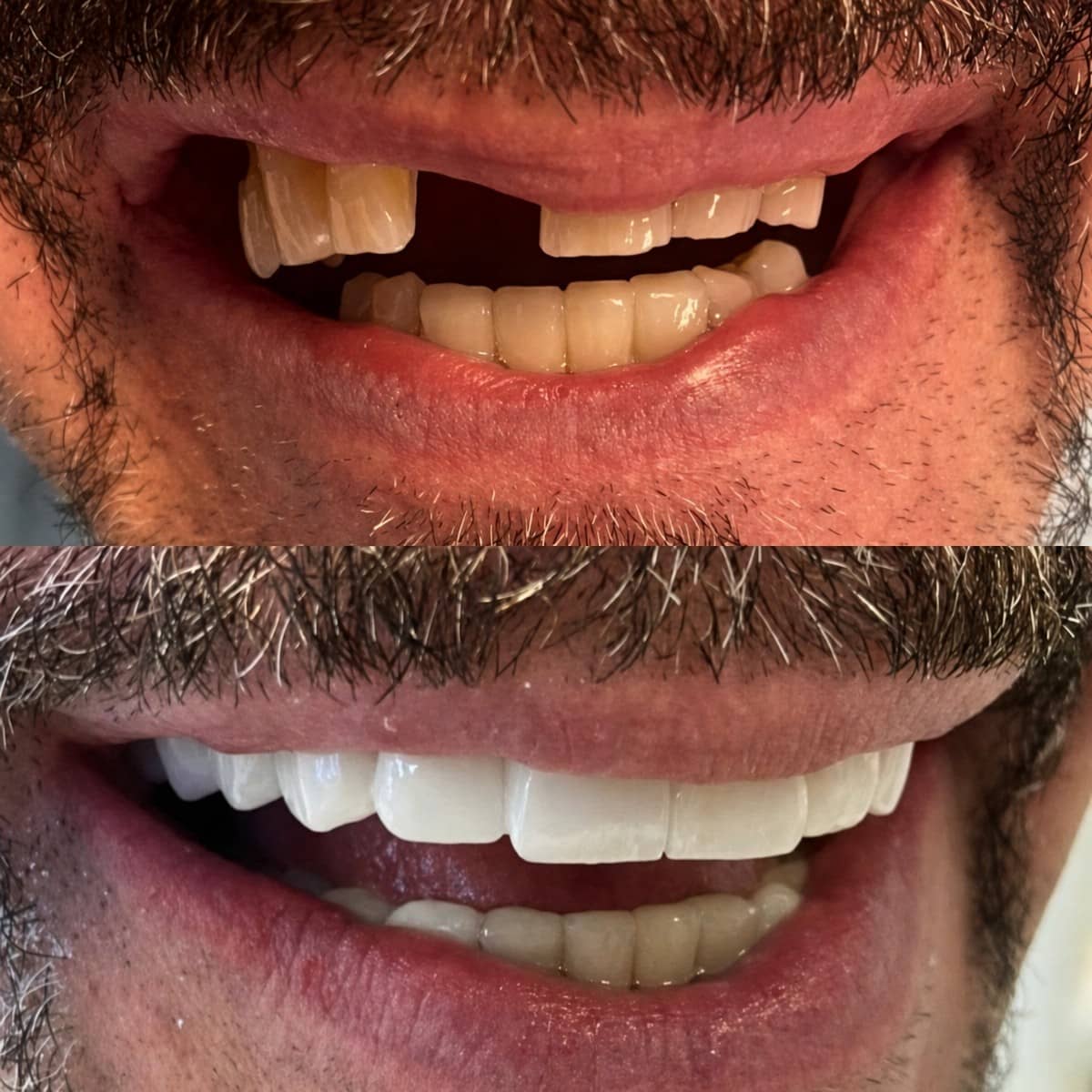 Case 13852 - zirconia crown installation