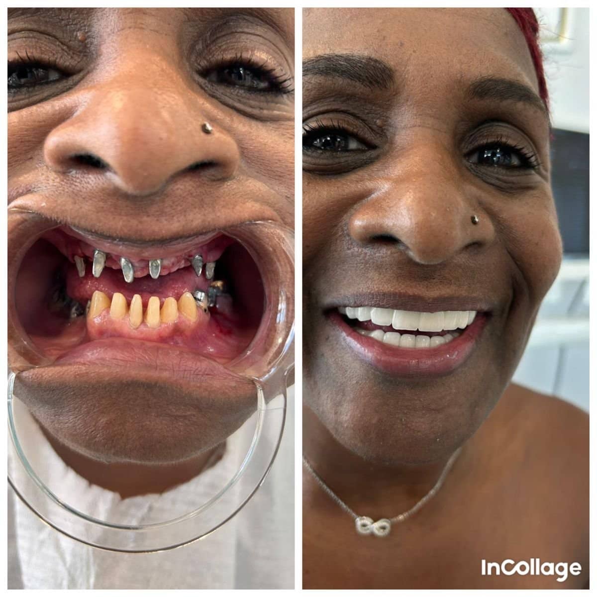 Case 13853 - dental implant