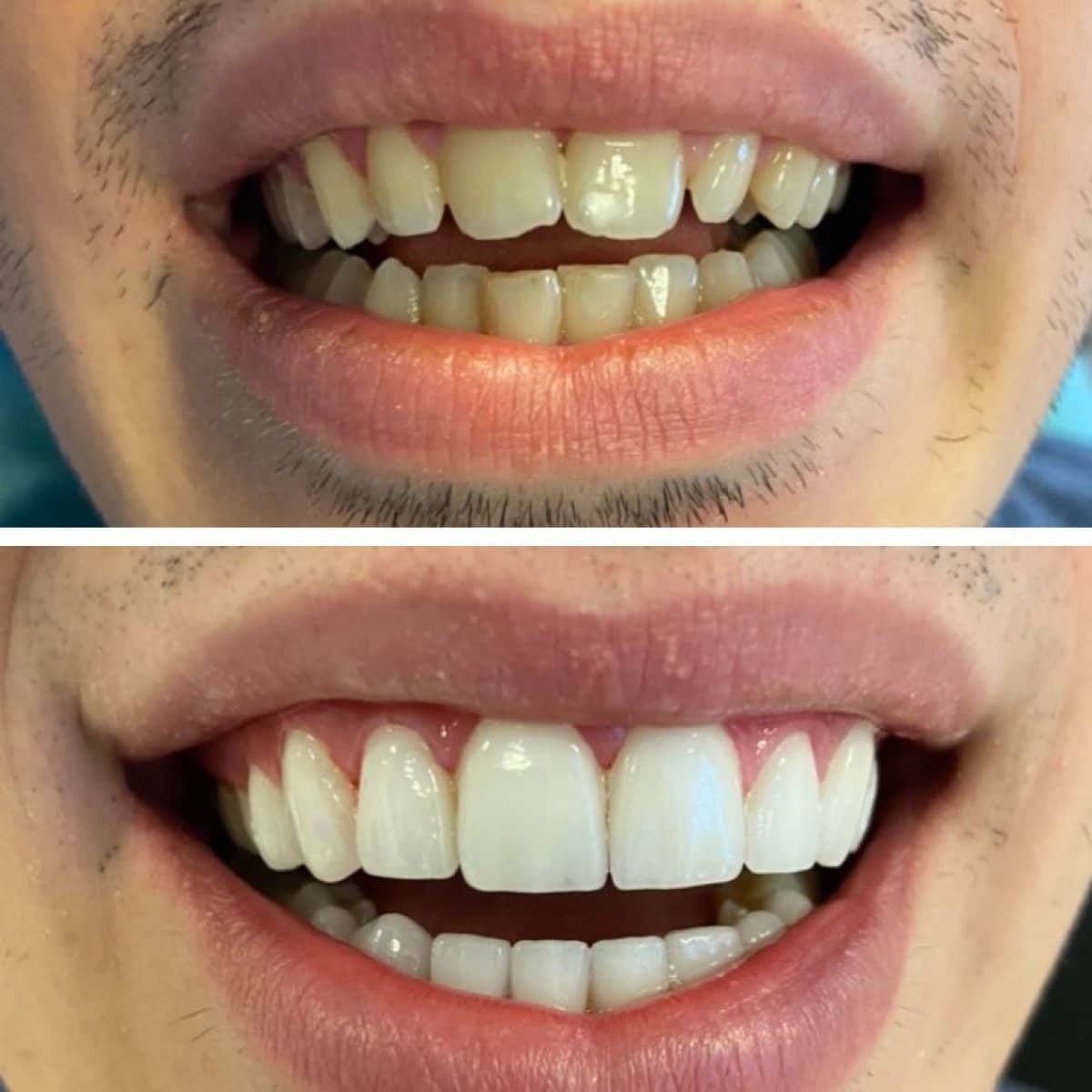 Case 13854 - veneers
