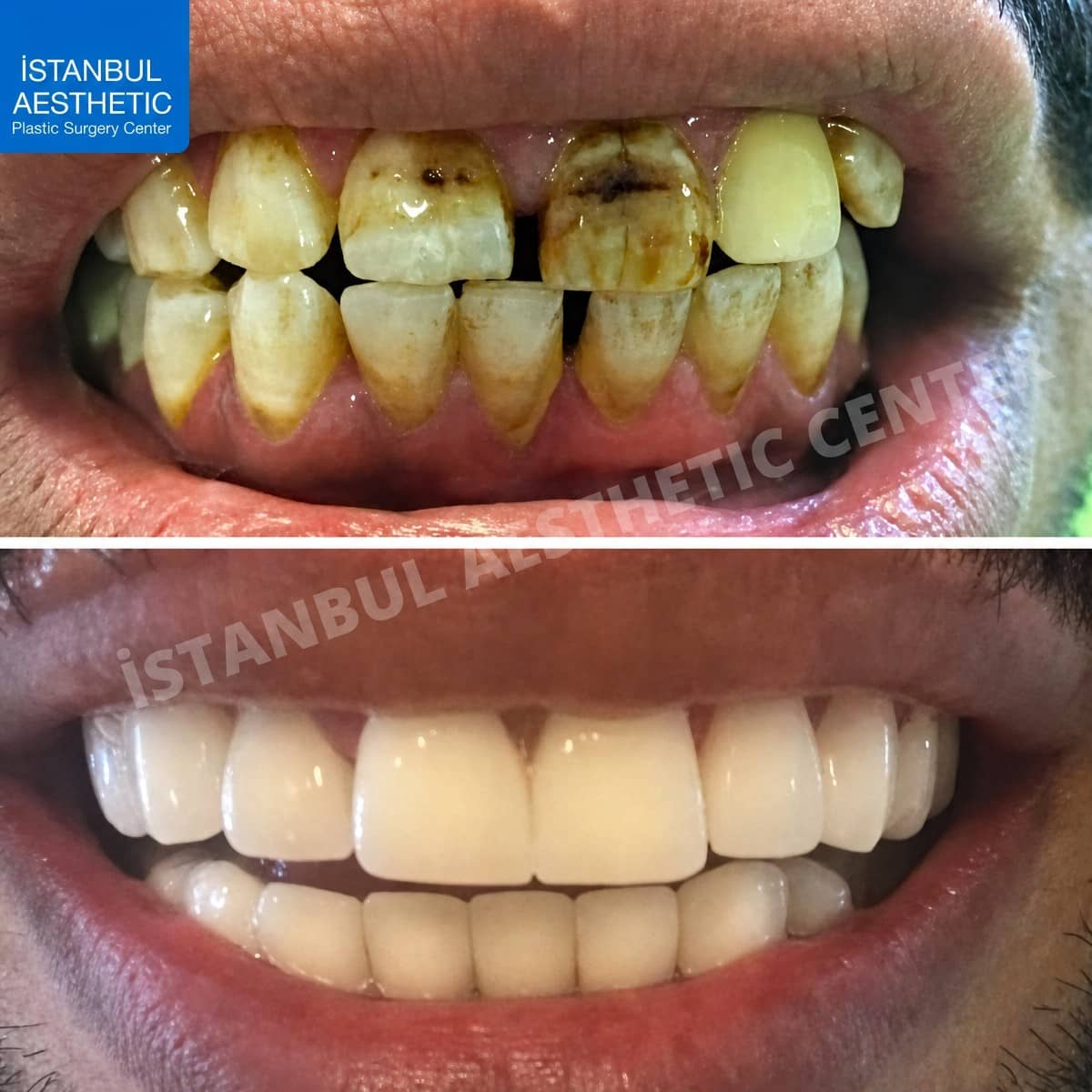 Case 13857 - zirconia crown