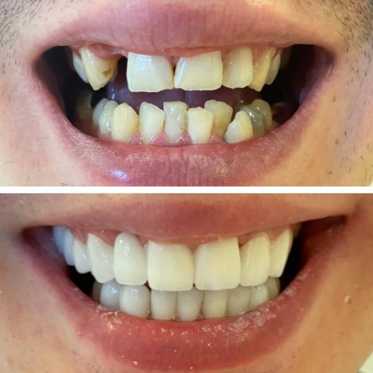 Case 13861 - dental crown installation