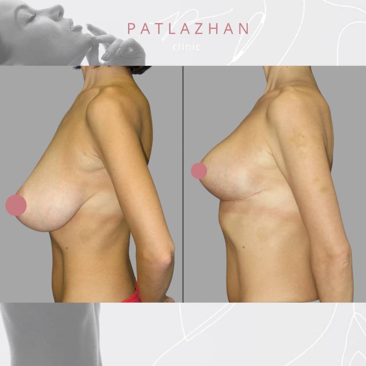 Case 13889 - mammoplasty