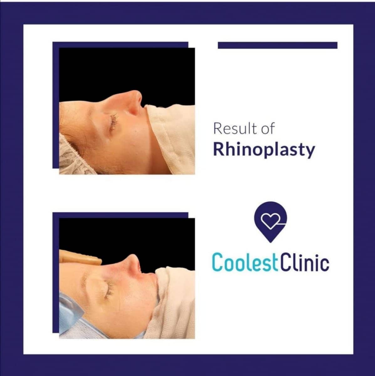Case 13902 - rhinoplasty