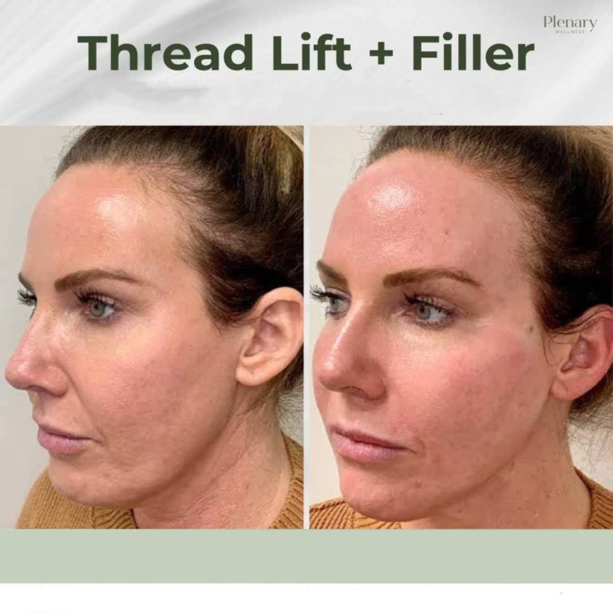 Case 13934 - thread lift and filler