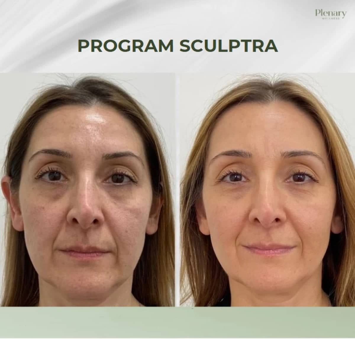 Case 13942 - Sculptra facial rejuvenation