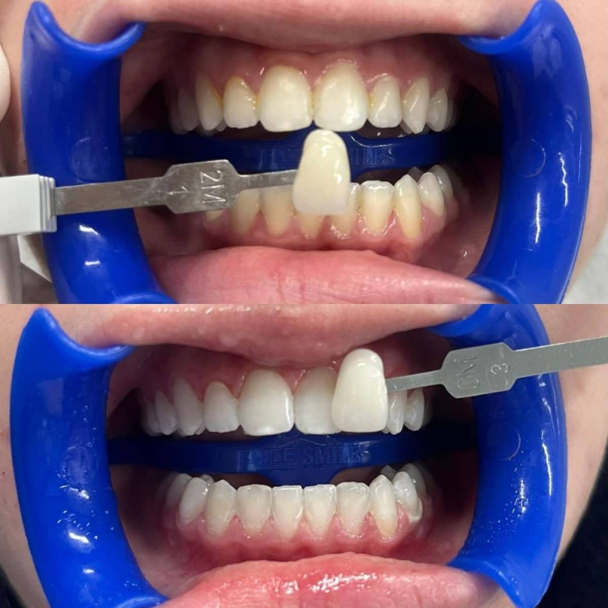 Case 13965 - teeth cleaning (scaling)