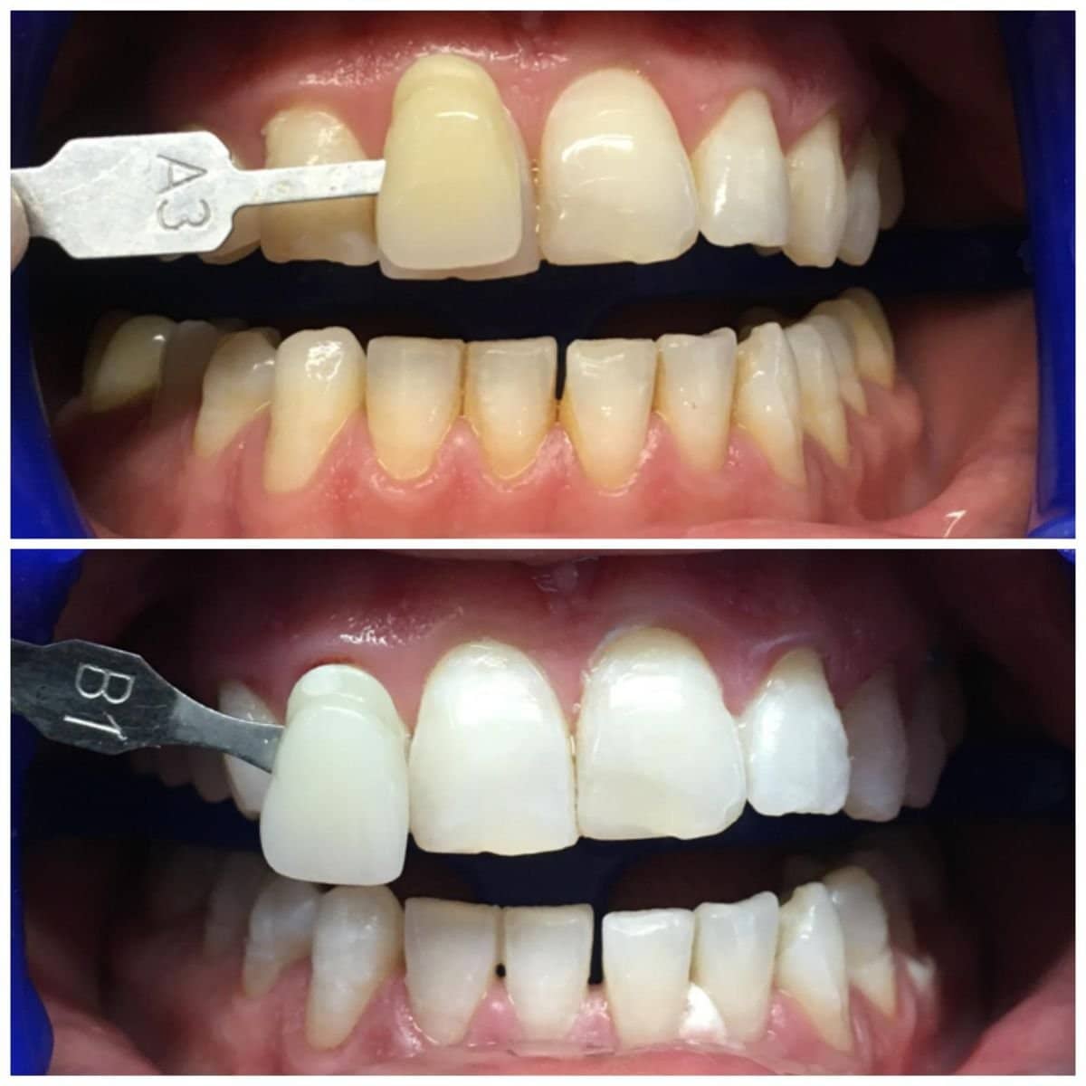 Case 13966 - teeth cleaning