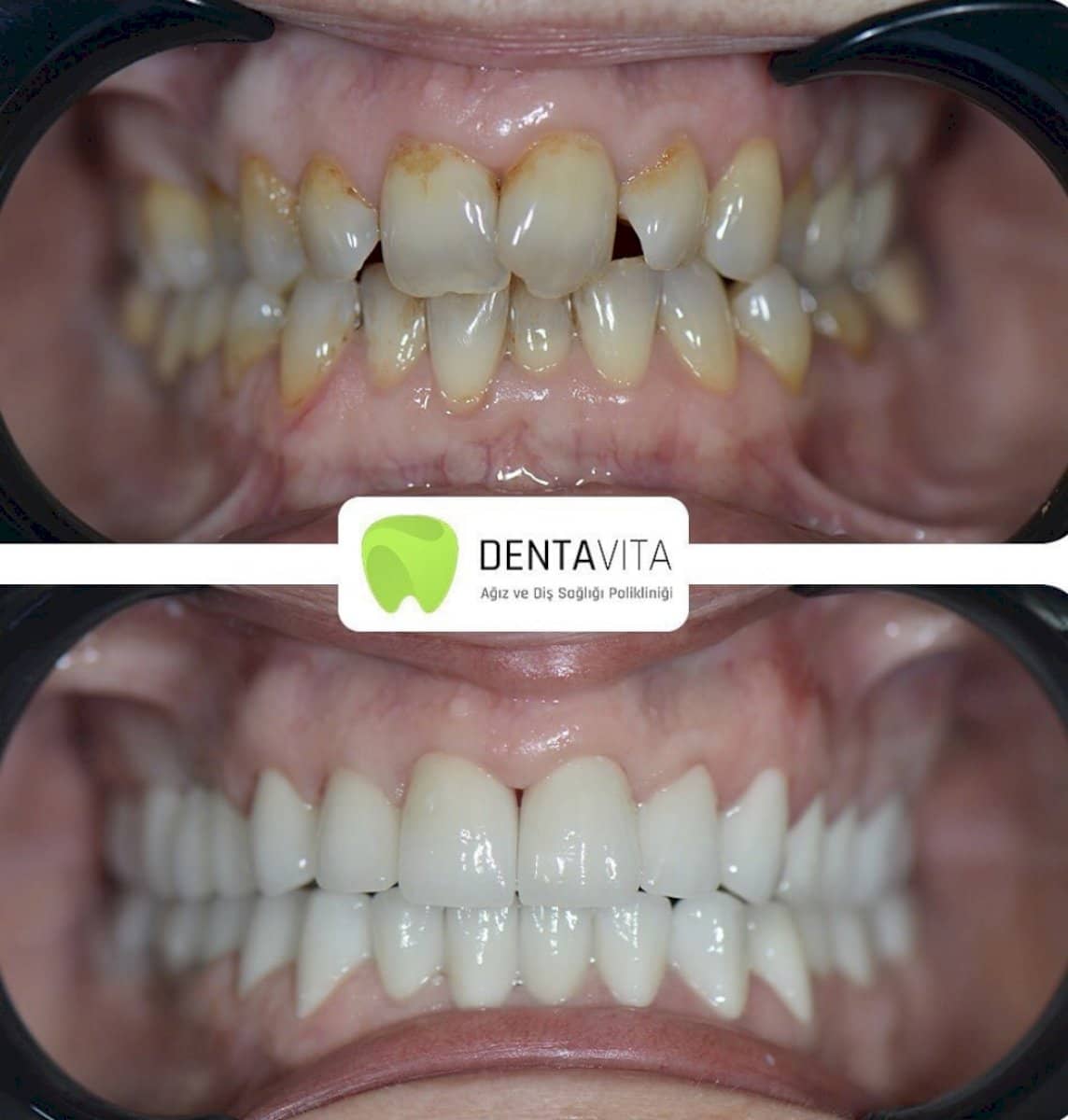 Case 13982 - composite veneer