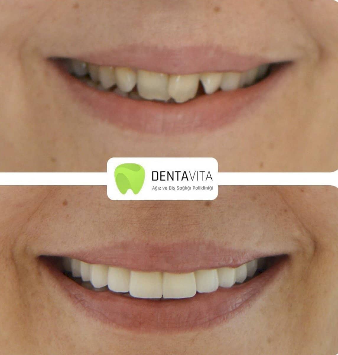 Case 13983 - composite veneer