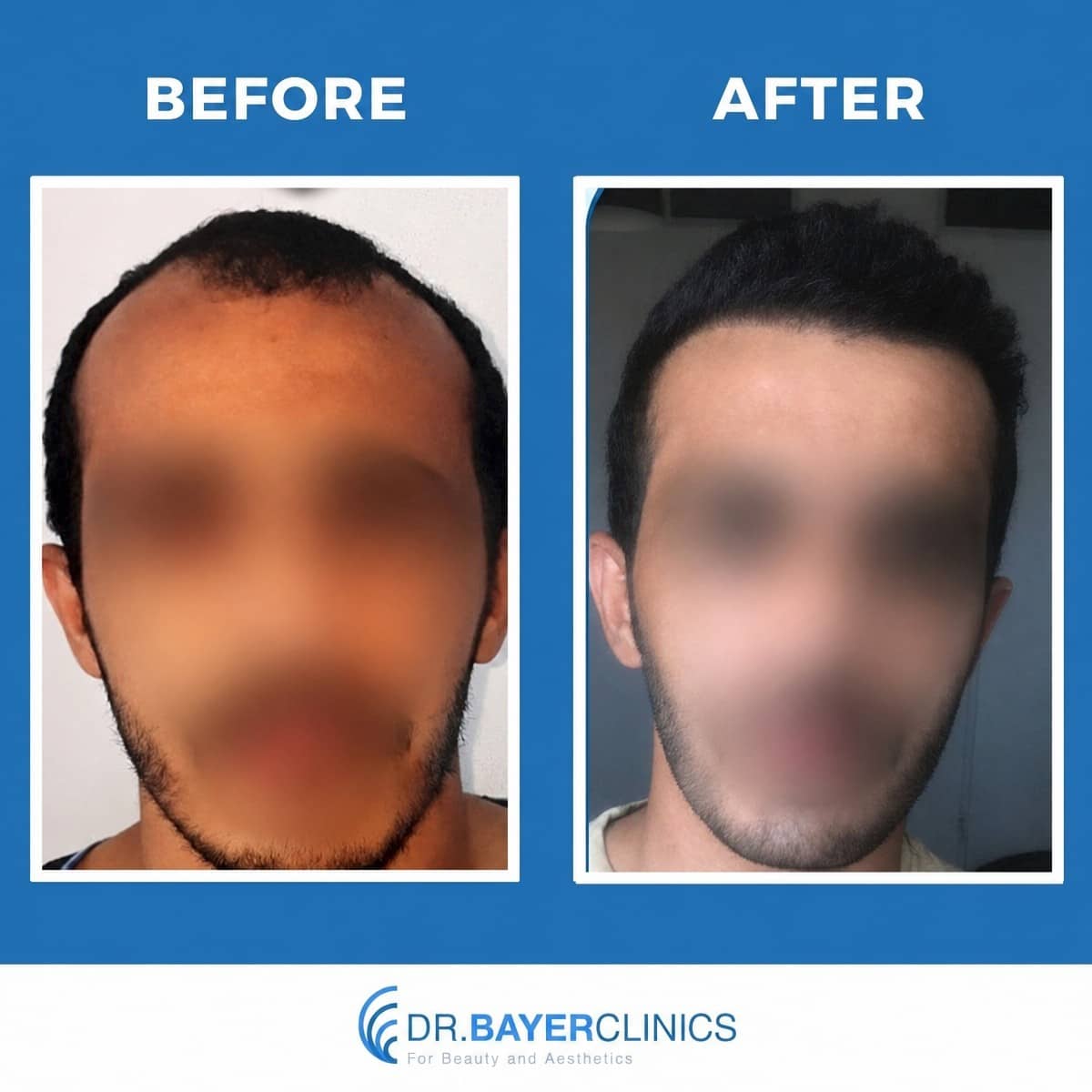 Case 13988 - DHI hair transplant
