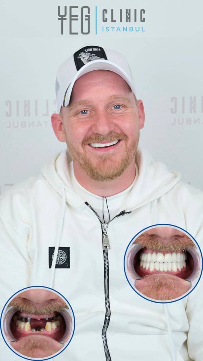 Case 14038 - full dentures installation